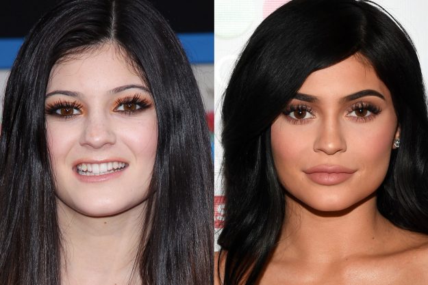Kylie Jenner Before and After Surgery